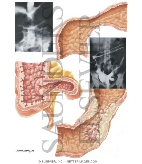 Watermarked preview of unlabeled image: Inflammatory Bowel Disease: Complications of Ulcerative Colitis
