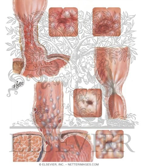 Watermarked preview of unlabeled image: Esophagitis: Varices