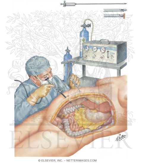 Watermarked preview of unlabeled image: Laparoscopy