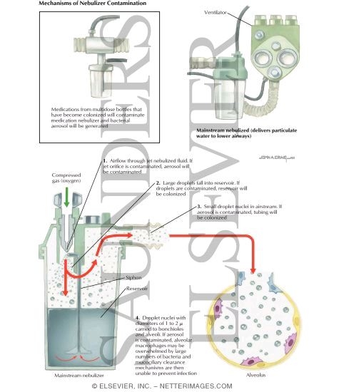 Watermarked preview of labeled image: Nosocomial Infections: Mechanisms of Nebulizer Contamination