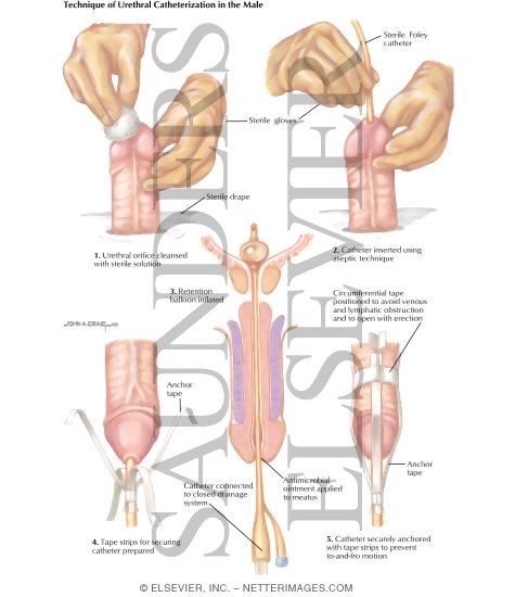 urinary catheterization