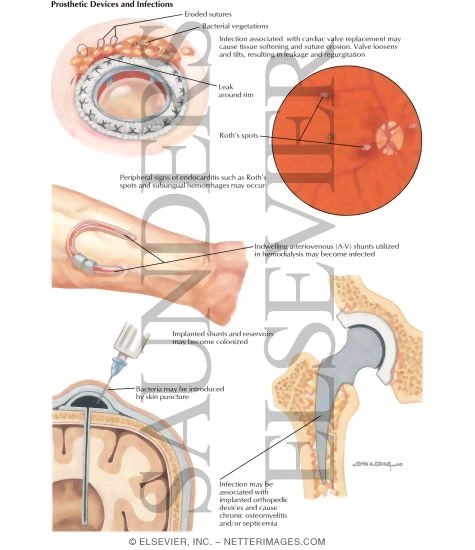 Watermarked preview of labeled image: Nosocomial Infections: Prosthetic Devices and Infections
