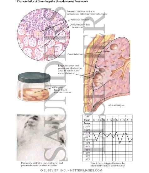Watermarked preview of labeled image: Nosocomial Infections: Characteristics of Gram-negative (Pseudomonas) Pneumonia