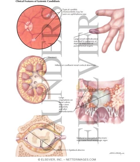 Systemic candida deals