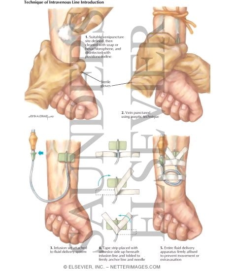 Watermarked preview of labeled image: Nosocomial Infections: Technique of Intravenous Line Introduction