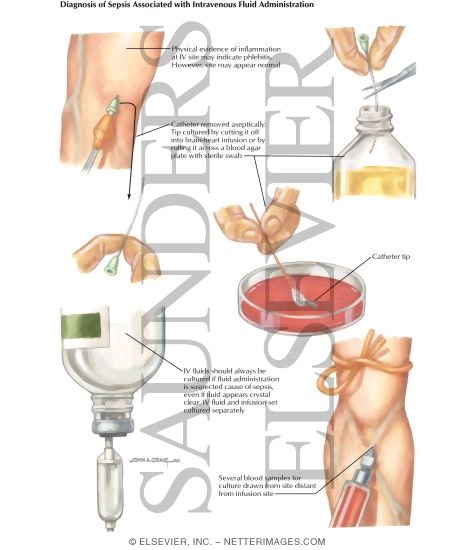 Watermarked preview of labeled image: Nosocomial Infections: Diagnosis of Sepsis Associated With Intravenous Fluid Administration