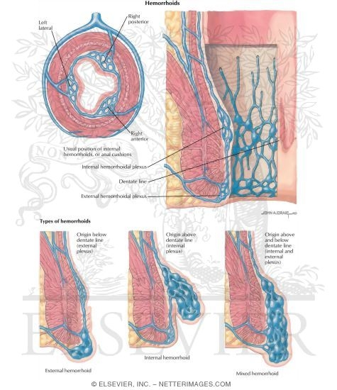 Watermarked preview of labeled image: Anorectal Disorders: Hemorrhoids
