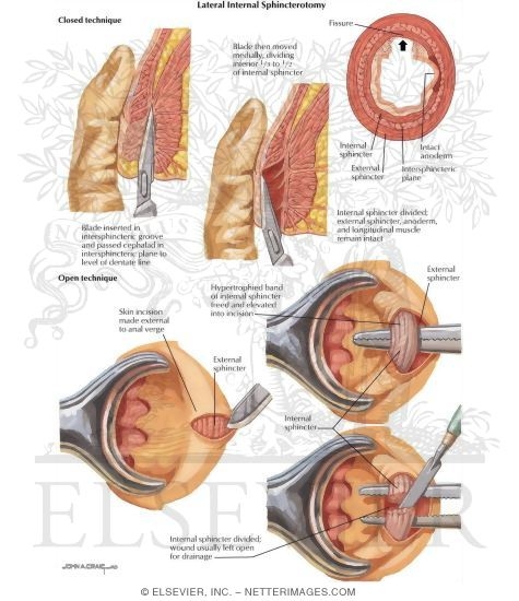 Lateral Internal Sphincterotomy