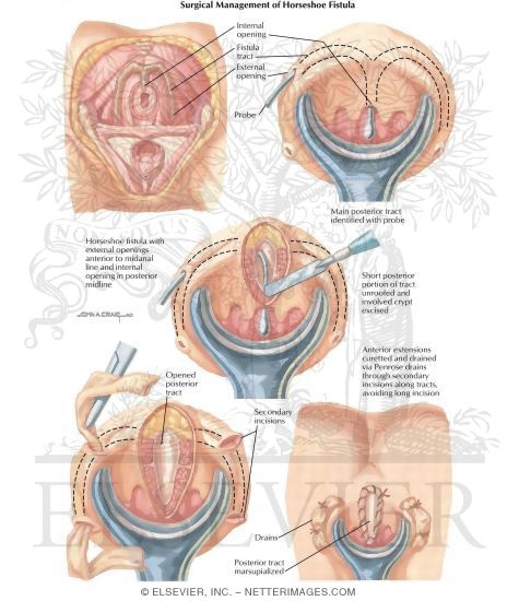 Anorectal Disorders: Surgical Management of Horseshoe Fistula