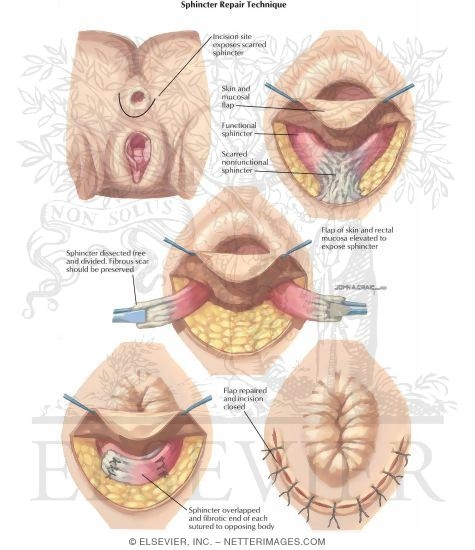 Anorectal Disorders: Sphincter Repair Technique