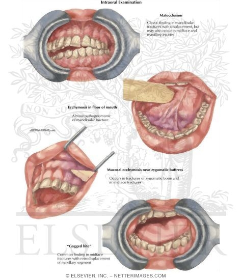 Watermarked preview of labeled image: Facial Trauma: Purple Gums