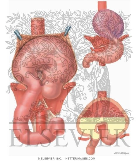 Watermarked preview of unlabeled image: Hiatus Hernia: Complications of Paraesophageal Hiatus Hernia