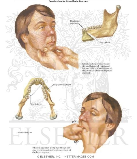 Facial Trauma: Broken Jaw and Jaw Exam