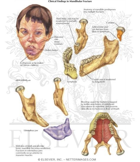 Facial Trauma: Broken Jaw and Child With Injured Chin