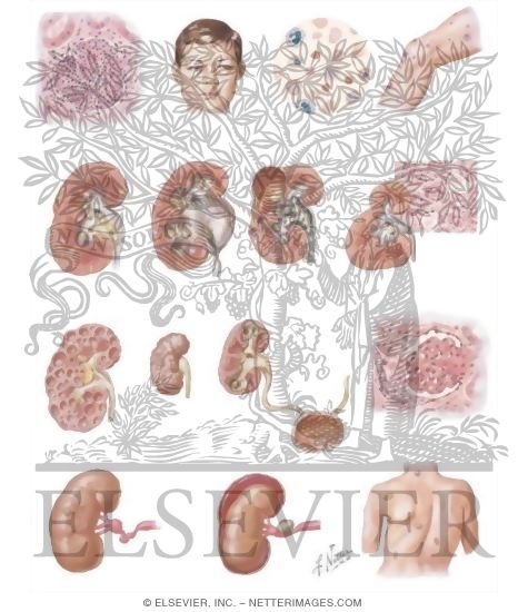 Watermarked preview of unlabeled image: Secondary Hypertension In Children and Adults