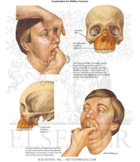 Facial Trauma: Examination for Mid-Face Fracture
