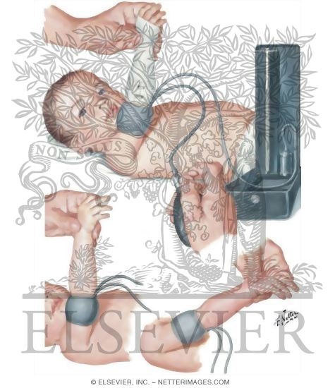 Watermarked preview of unlabeled image: Measurement of Blood Pressure In Infants (Flush Method)