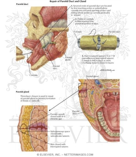 Watermarked preview of labeled image: Facial Trauma: Repair of Parotid Duct and Gland