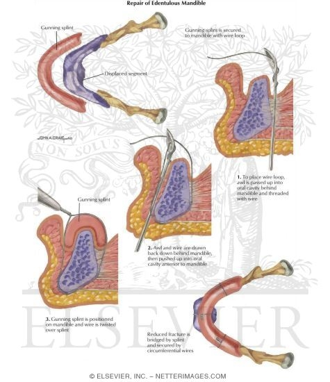 Watermarked preview of labeled image: Facial Trauma: Repair of Edentulous Mandible