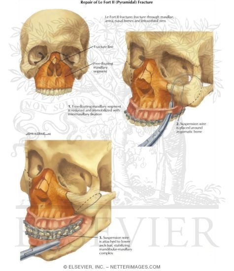 Facial Trauma: Repair of Le Fort II Pyramidal Fracture