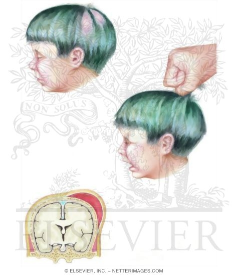 Watermarked preview of unlabeled image: Child Abuse: Head Trauma
