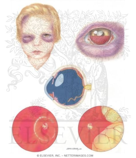 Watermarked preview of unlabeled image: Child Abuse: Ocular Injuries