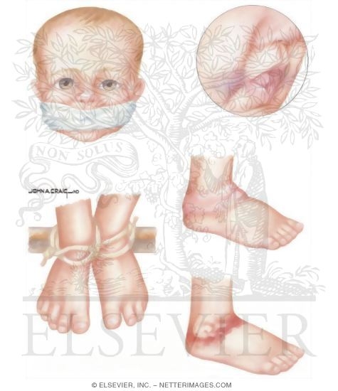 Watermarked preview of unlabeled image: Child Abuse: Restraint Injuries