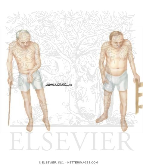 Hysterical Conversion Reactions: Patient Observation and Gait Observation