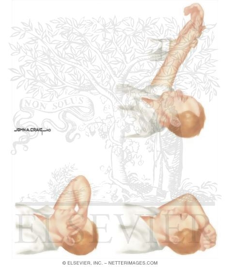 Watermarked preview of unlabeled image: Hysterical Conversion Reactions: Test for Paralysis of the Upper Extremity