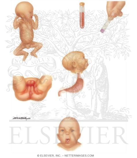 Watermarked preview of unlabeled image: Birth Defects: Signs and Symptoms of Metabolic Disease In Infancy
