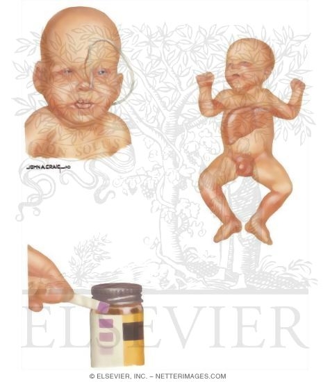 Watermarked preview of unlabeled image: Birth Defects: Disorders of Propionate Metabolism - Signs and Symptoms