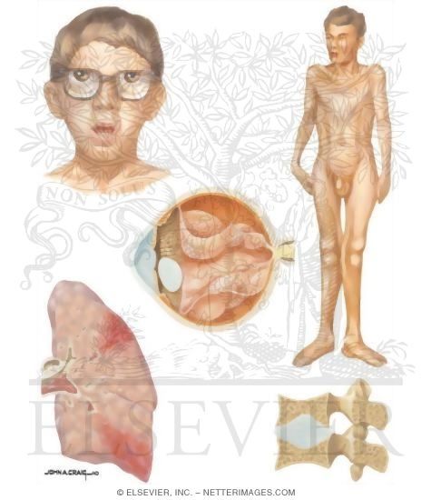 Birth Defects: Homocystinuria - Signs and Symptoms
