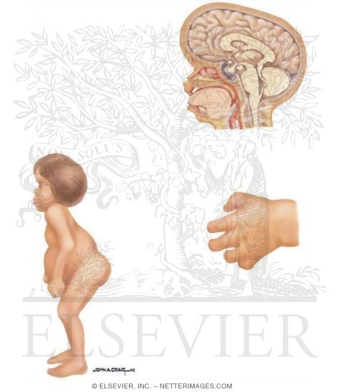 Watermarked preview of unlabeled image: Birth Defects: Mucopolysaccharidoses - Dystosis Multiplex