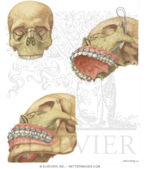 Facial Trauma: Repair of Le Fort III Fracture (Craniofacial Dysjunction)