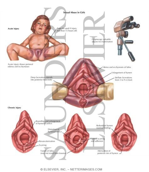 gynecology and sexual abuse gynecology and sexual abuse