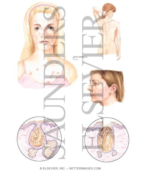 Watermarked preview of unlabeled image: Acne