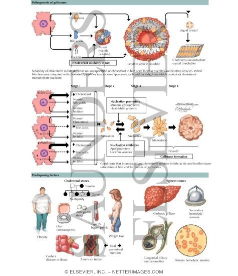 Watermarked preview of labeled image: Cholelithiasis