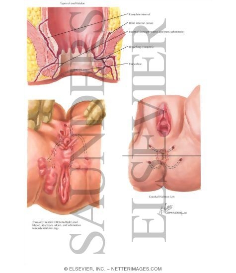 Anorectal Fistula