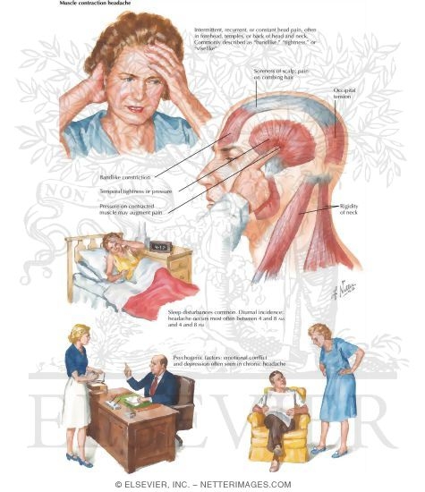 Watermarked preview of labeled image: Muscle Contraction Headache