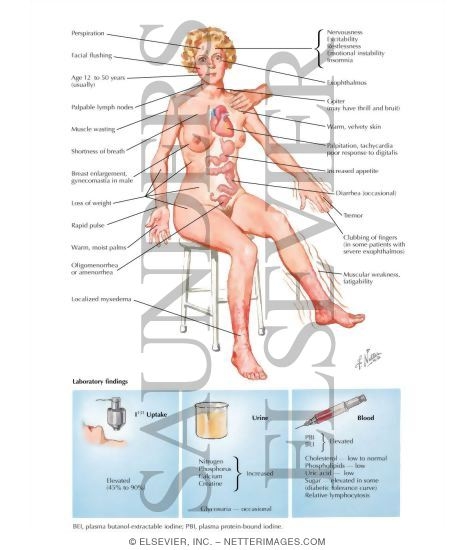Watermarked preview of labeled image: Hyperthyroidism