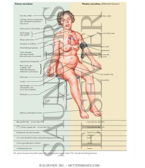 Primary And Secondary Adult Myxedema Hypothyroidism Primary And Secondary Adult Myxedema Hypothyroidism