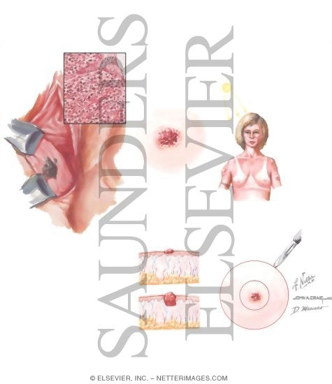 Watermarked preview of unlabeled image: Melanoma