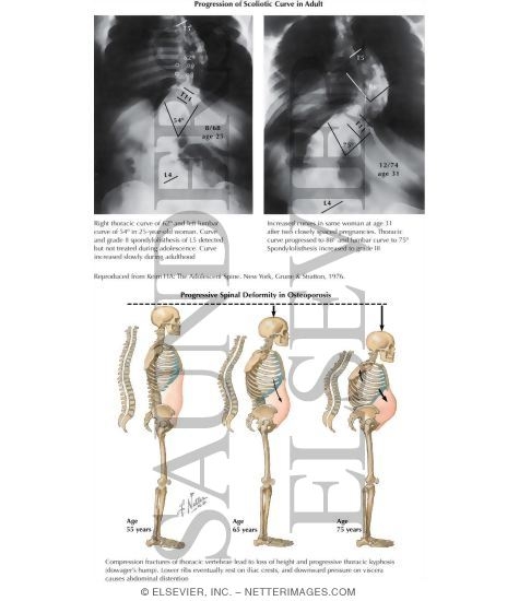 Watermarked preview of labeled image: Progression of Scoliotic Curve In Adult