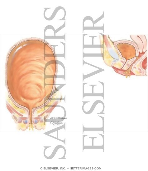 Watermarked preview of unlabeled image: Urinary Incontinence: Bypass, Overflow