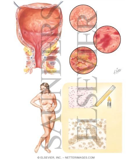 Watermarked preview of unlabeled image: Urinary Tract Infection