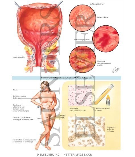 Uraniry tract infection