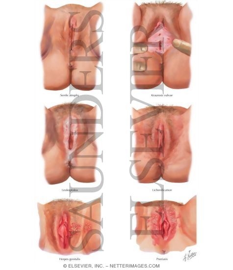 Vulvar Lesions