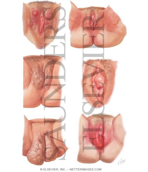 Vulvar Lesions