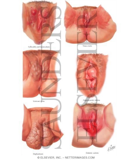 Gavin recommends Small lesions on vulva Elias recommend Free nude twink videos