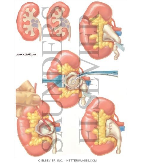 Urinary Calculi: Simple Pyelolithotomy